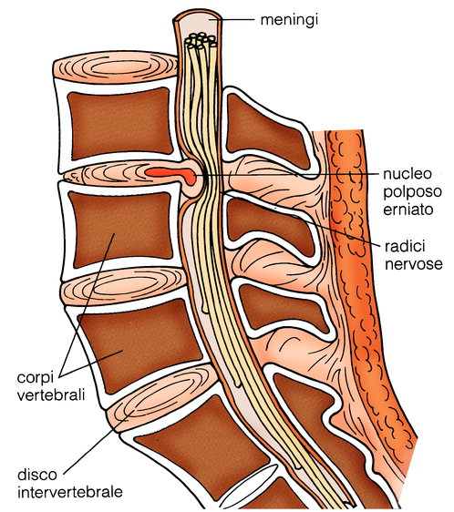 dolore schiena cronico