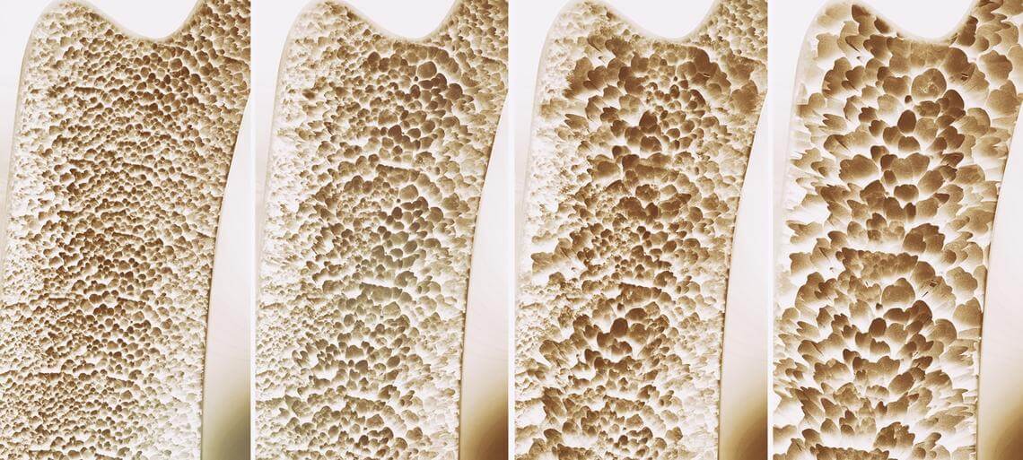 Prevenzione dell’osteoporosi: tutti i consigli